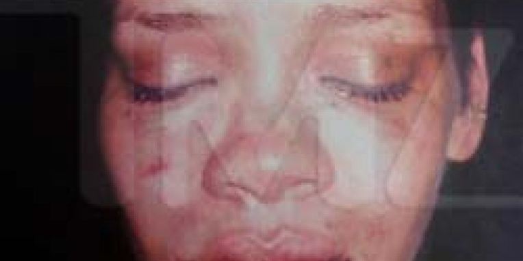 Sådan så Rihanna ud i 2009, efter at hendes daværende kæreste Chris Brown slog hende i ansigtet.