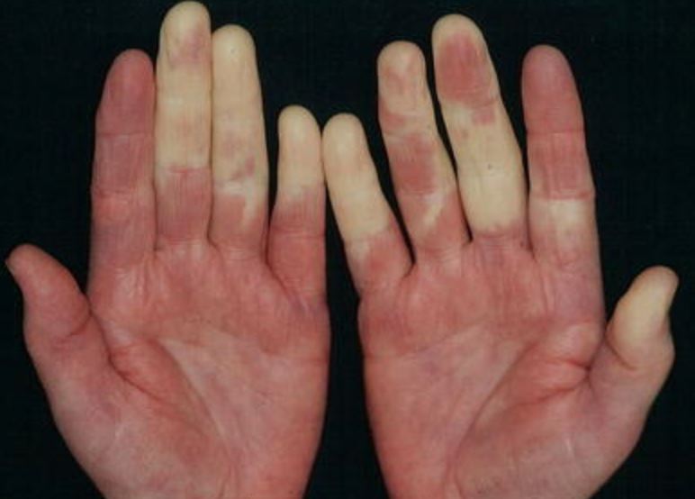 Et sæt hænder med nogle kridhvide fingre
