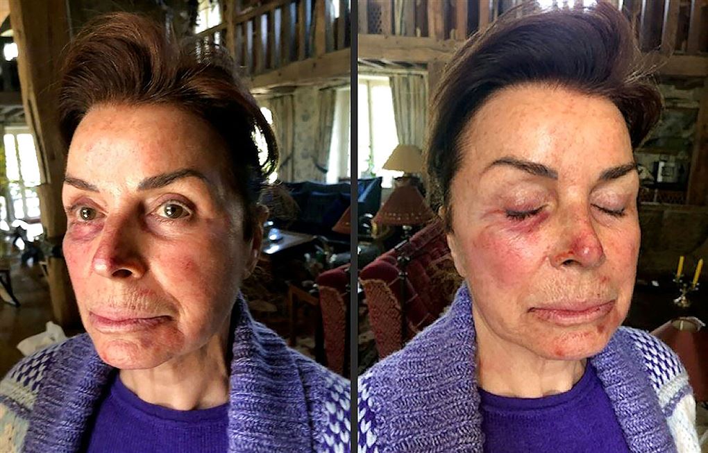 to billeder af en forslået Dominique Tapie